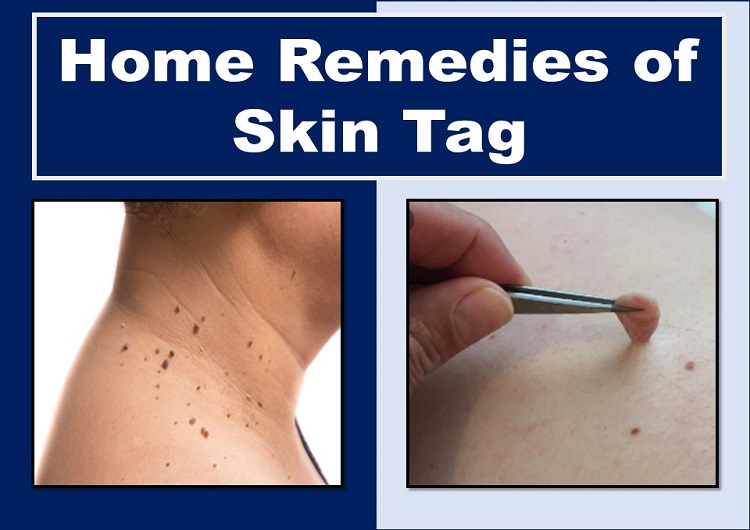 effective-method-to-remove-skin-tags