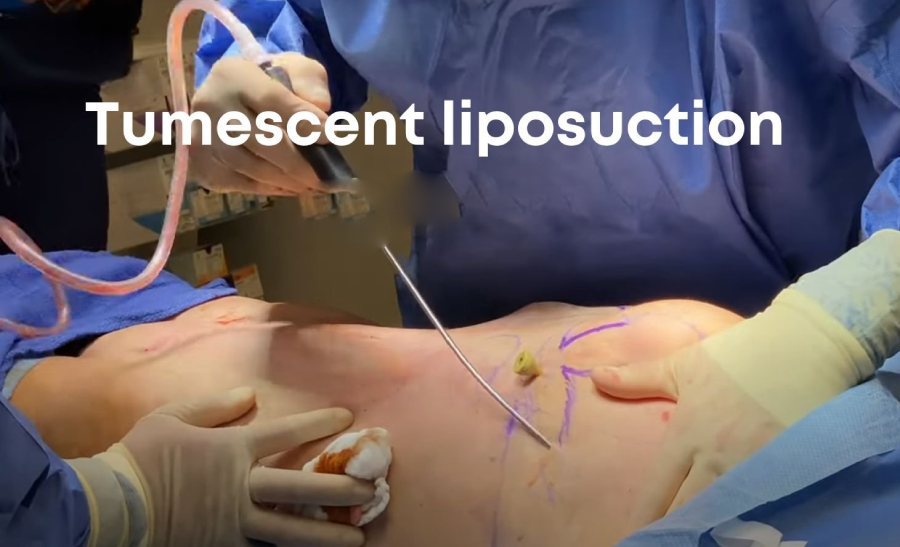 Tumescent liposuction