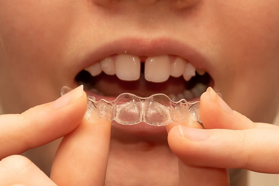 how Invisalign work